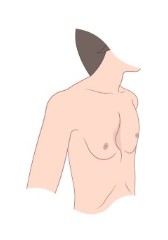 Pectus Excavatum Illustration