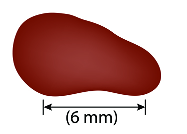 Image of mole showing evolving shape which can indicate melanoma