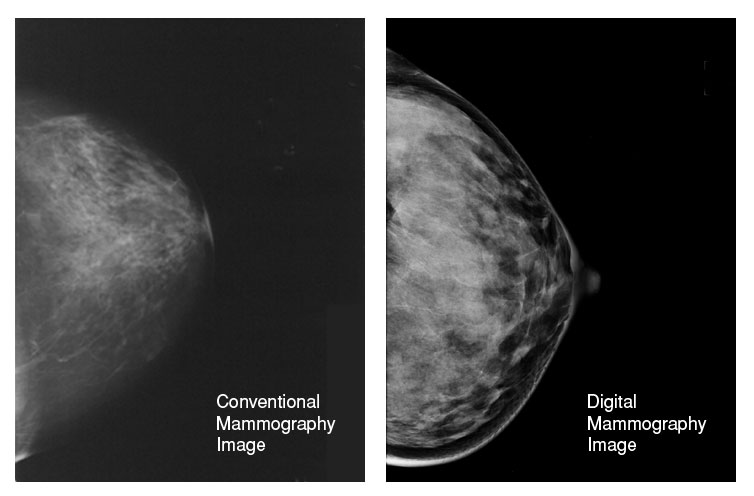 digital mammography comparison