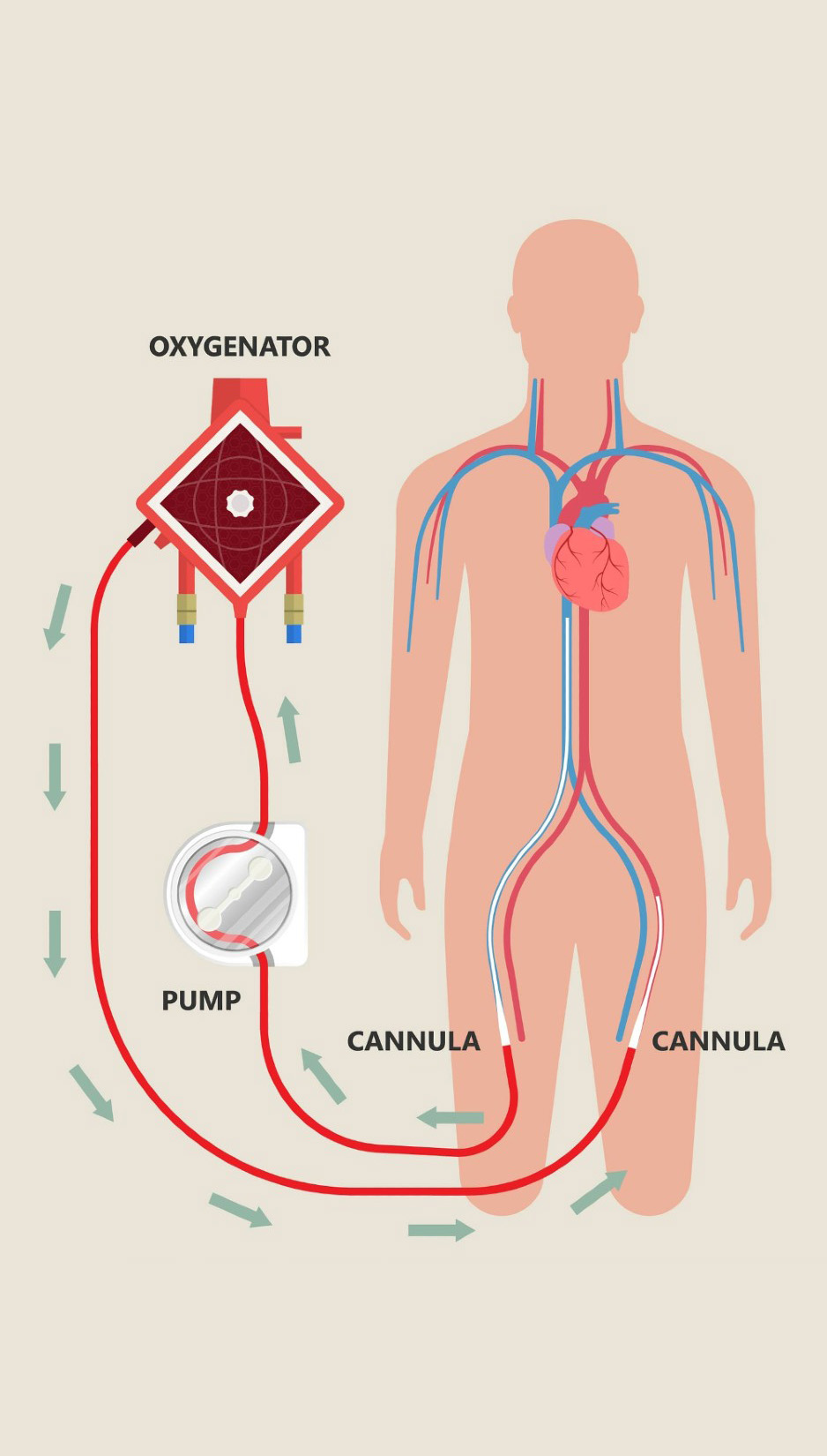 ECMO VA Illustration
