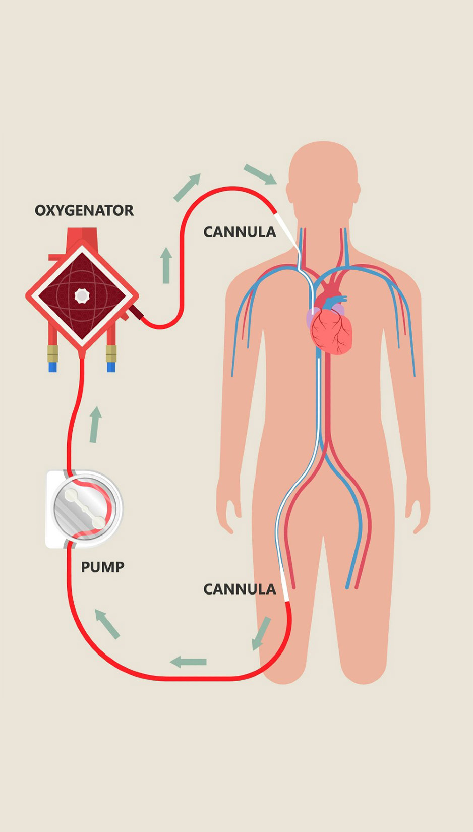 VV Ecmo diagram